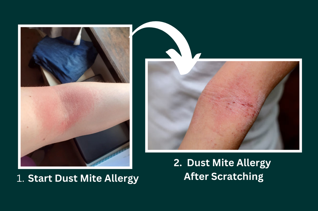 itchy red skin dust mite allergy