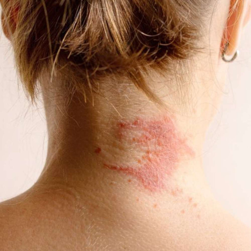 Sensitive Skins & Eczema